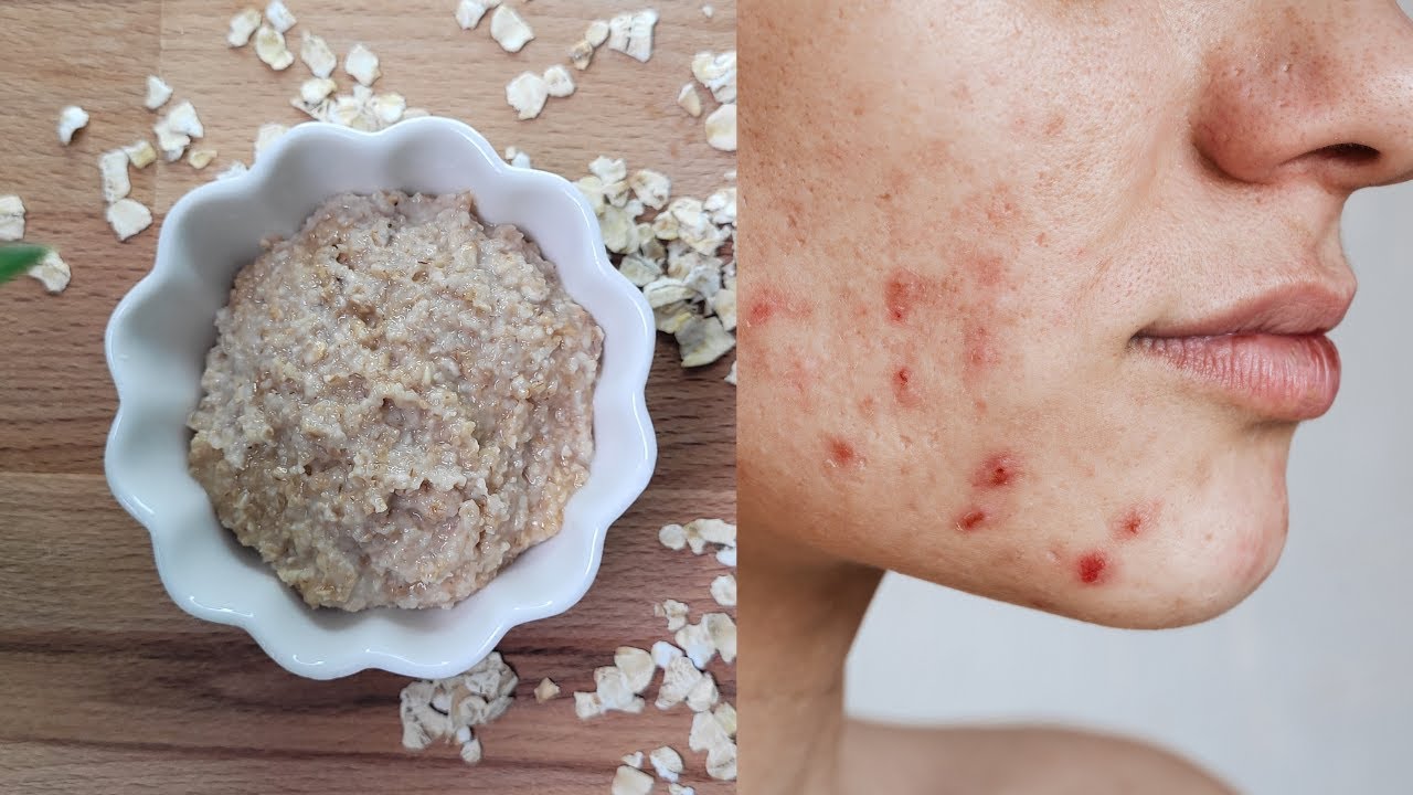 Get Rid Of Acne-Prone Skin with DIY Oatmeal Face Masks