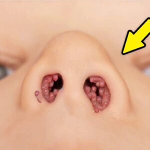 Strange Spots Suddenly Appear Inside Little Girl’s Nose – Then the Unthinkable Happens!