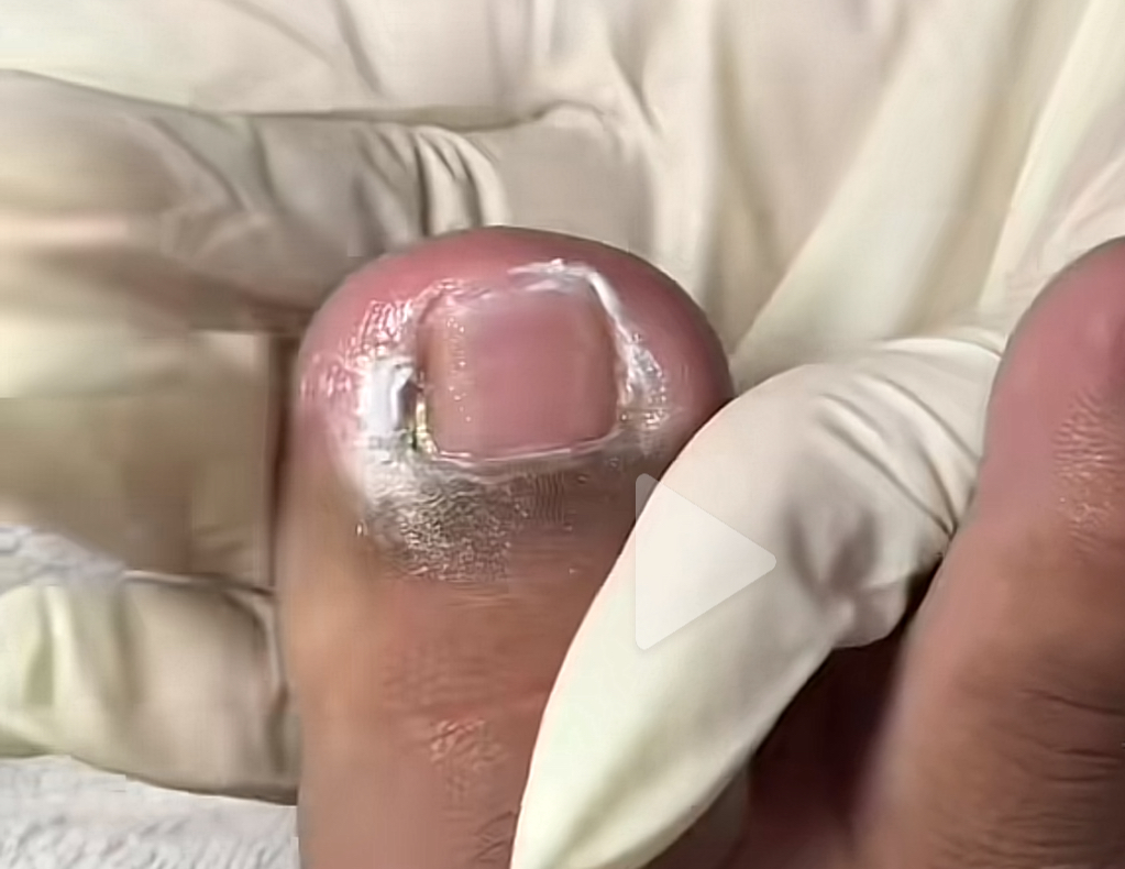 Ingrown Toenail Treatment – Professional Removal